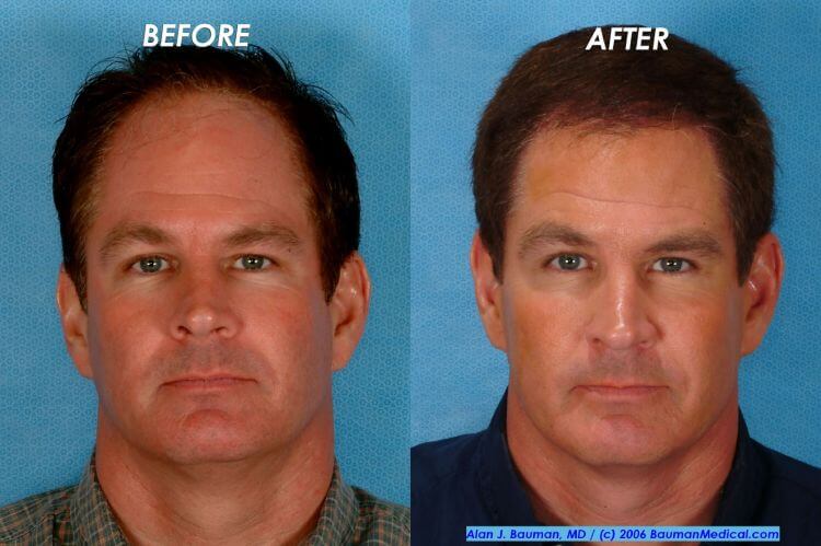 40 y/o Male Hair Transplant Results