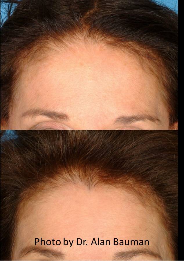 Female Before and After transplant: Temples, hairline, including restored “widow’s peak”