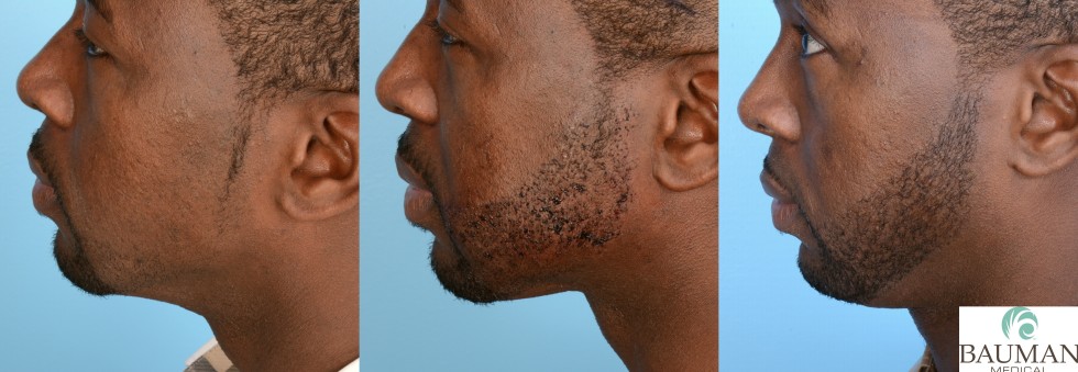 Before, 24-Hours And 12-Months After Beard Transplantation By Dr. Alan Bauman