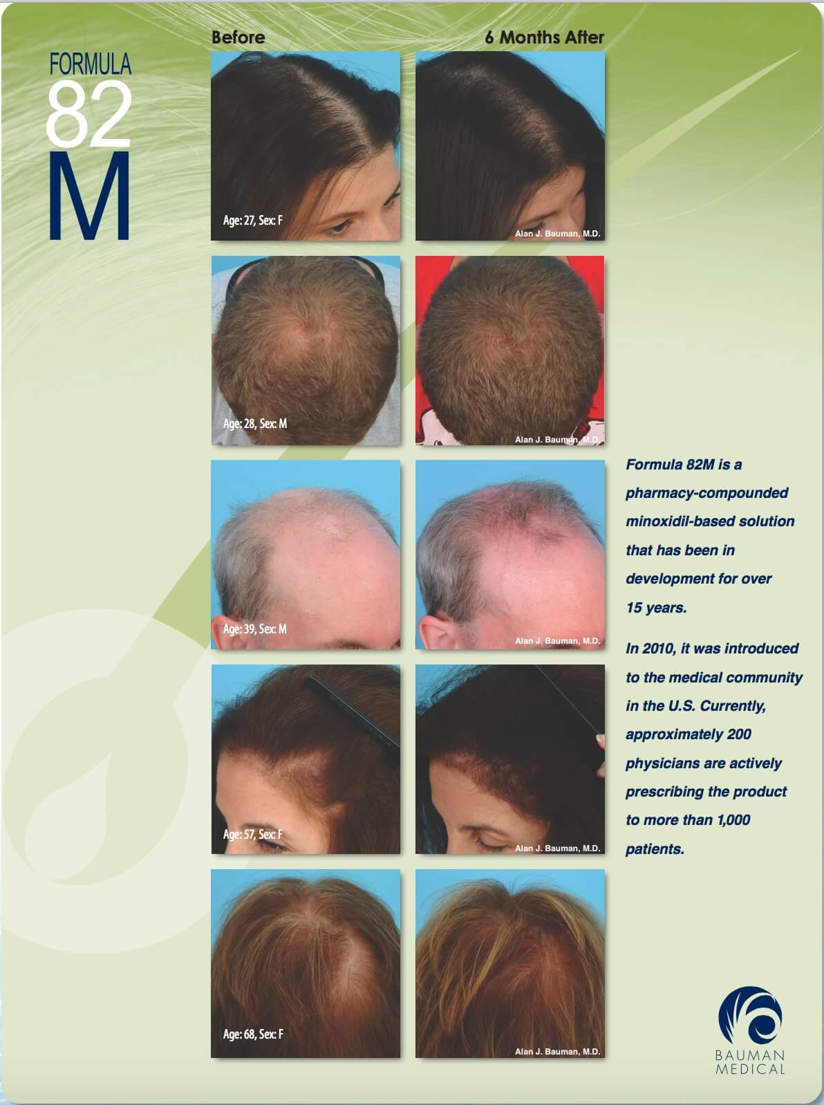 Customized Minoxidil Formula 82M Compounded Minoxidil Formula 82M Dralanbauman Rogaine Alternative