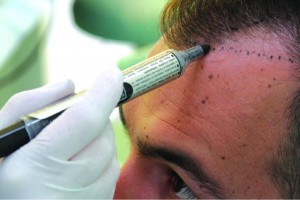 Article: &Quot;Hair Transplant Surgery: Unplugged&Quot; By Dr. Alan J. Bauman Hair Transplant Surgery