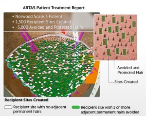 Artas Robotic Fue Hair Transplant Artas Recipient Site Creation Avoids Healthy Hair