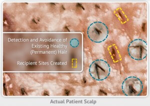 Artas Robotic Fue Hair Transplant Artas Avoids Healthy Hair