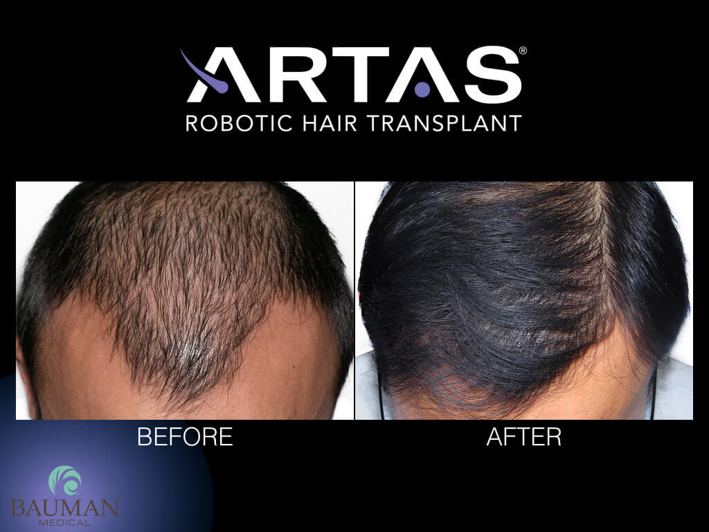 Artas Robotic Fue Hair Transplant Artas At Dralanbauman - Before-After.003