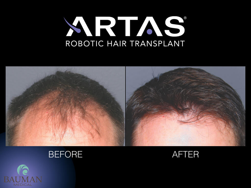 Artas Robotic Fue Hair Transplant Artas At Dralanbauman - Before-After.004