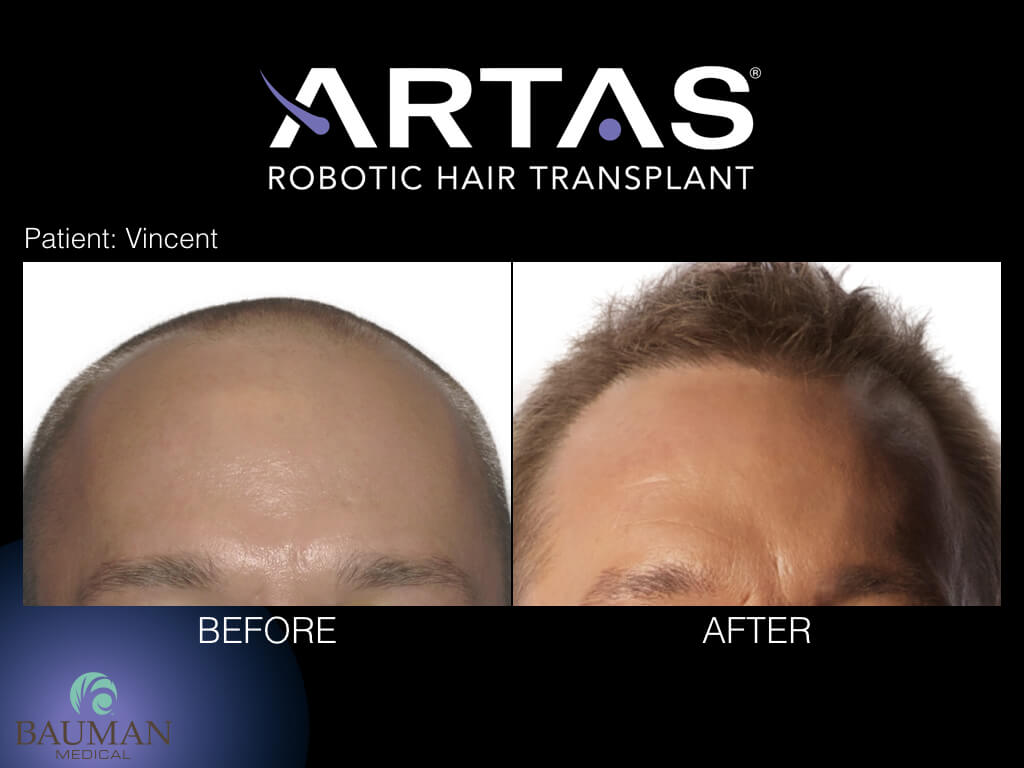 Artas Robotic Fue Hair Transplant Artas At Dralanbauman - Before-After.005