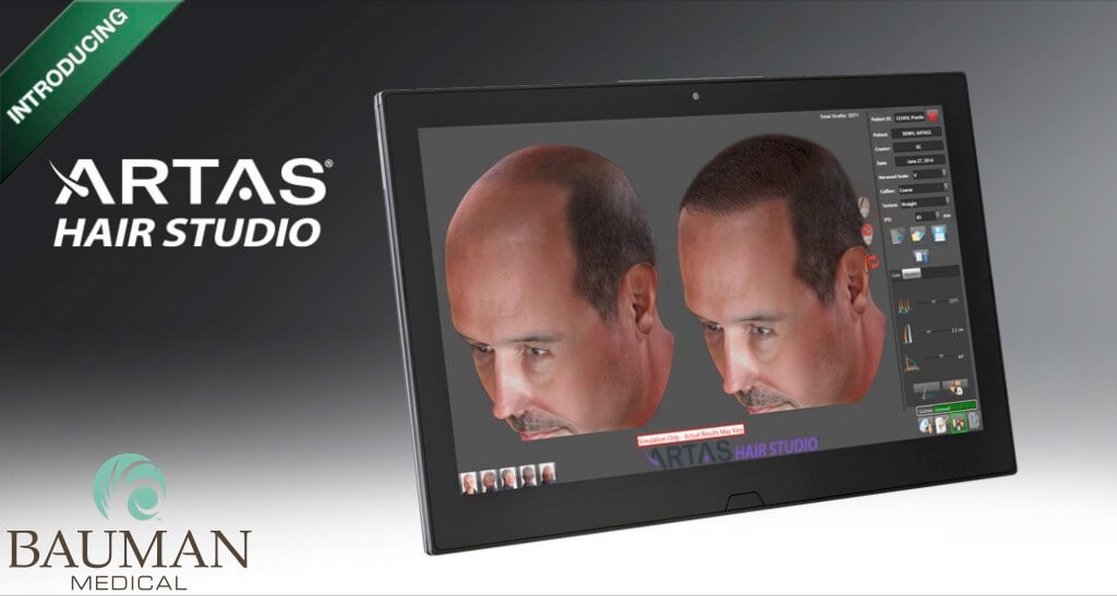 Artas Robotic Fue Hair Transplant Artas Hair Studio 3D Preview Dralanbauman