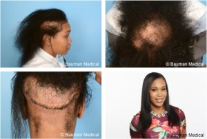 Press Release: Medical Grade Hair And Scalp Prosthetic Made With 3D-Printing For Dr. Alan J. Bauman'S Hair Transplant Patient Unveiled At International Alopecia Conference Press Release: Medical Grade Hair And Scalp Prosthetic Made With 3D-Printing For Dr. Alan J. Bauman'S Hair Transplant Patient Unveiled At International Alopecia Conference - -