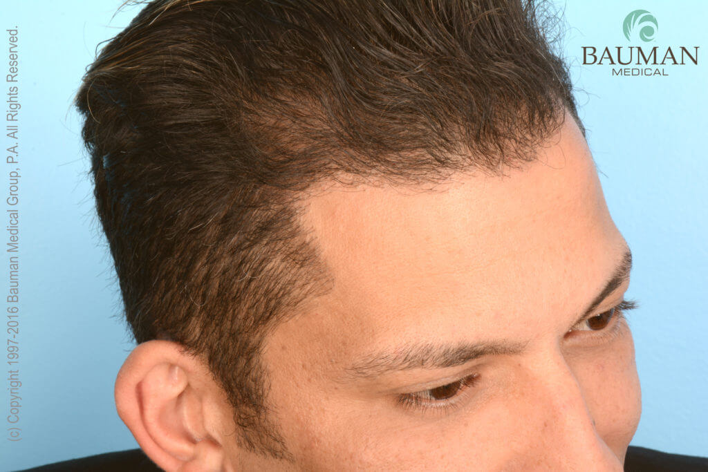 Article: An Undetectable Hair Transplant Natural Artistic Hairline - Patient Martino Cartier 1-Year After Dralanbauman Hair Transplant. See Natural Hairline Results.