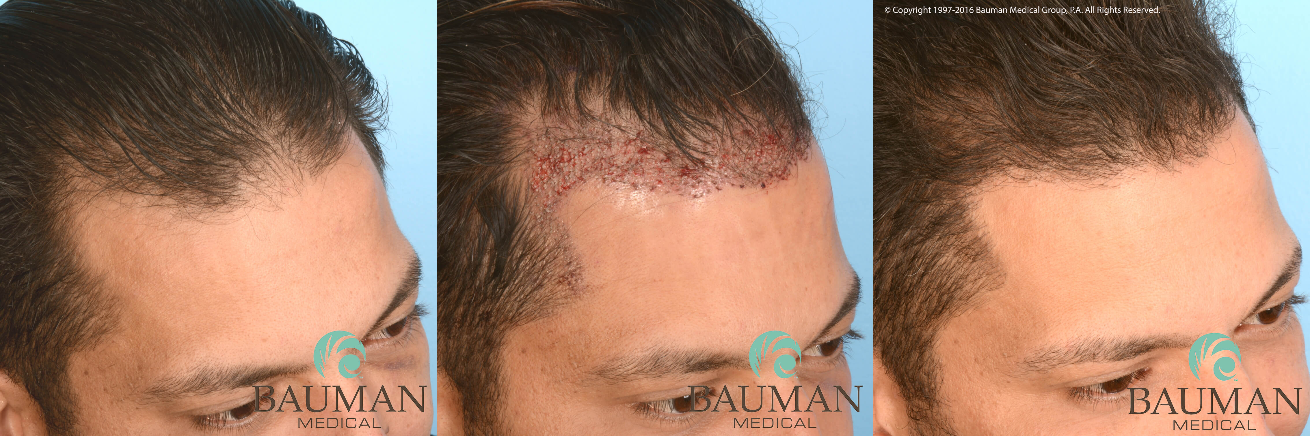 Article: An Undetectable Hair Transplant Before, 24Hrs &Amp; 1Year After An Artistic Hairline Transplant With Dr. Alan Bauman