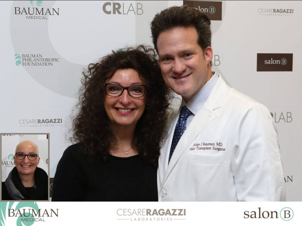 Press Release: Alopecia Areata Awareness Month: New Treatment Utilizes 3D-Printing Technology Dr. Bauman &Amp; Claudia, Alopecia Areata Totalis Patient Before And After Photo Of Crlab Cnc Hair &Amp; Scalp Prosthesis