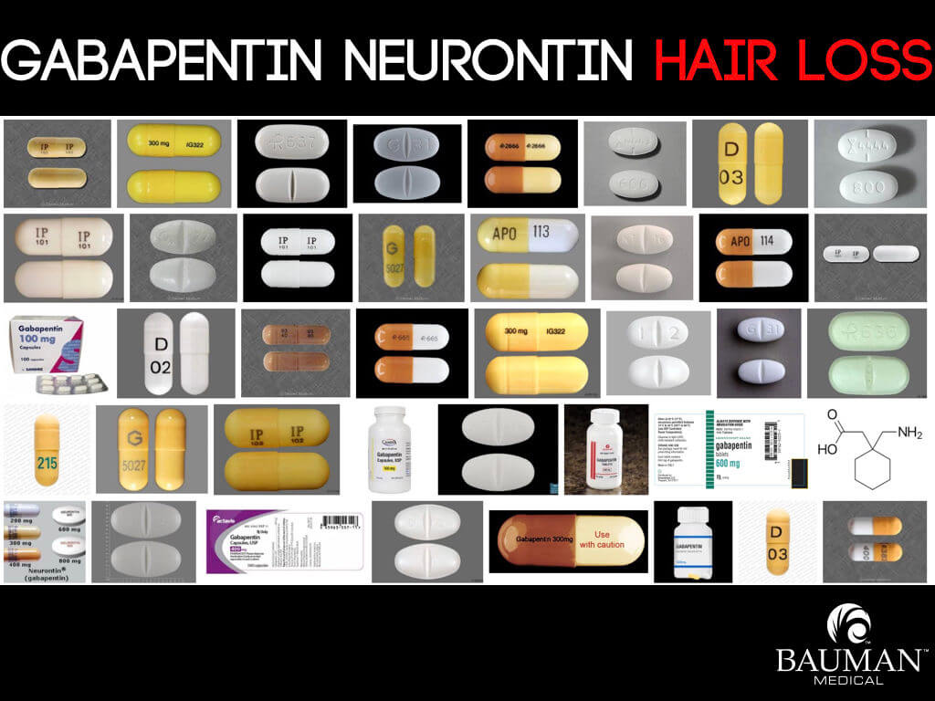 Does Gabapentin Make Your Hair Fall Out? Does-Gabapentin-Cause-Hair-Loss