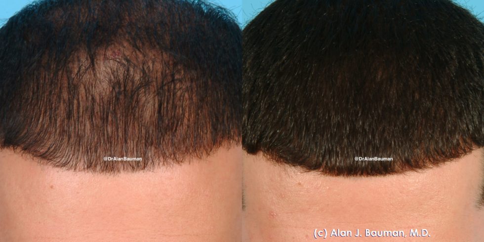 Vampire-Prp Treatment For Hair Loss Vampire-Prp Treatment For Hair Loss - -
