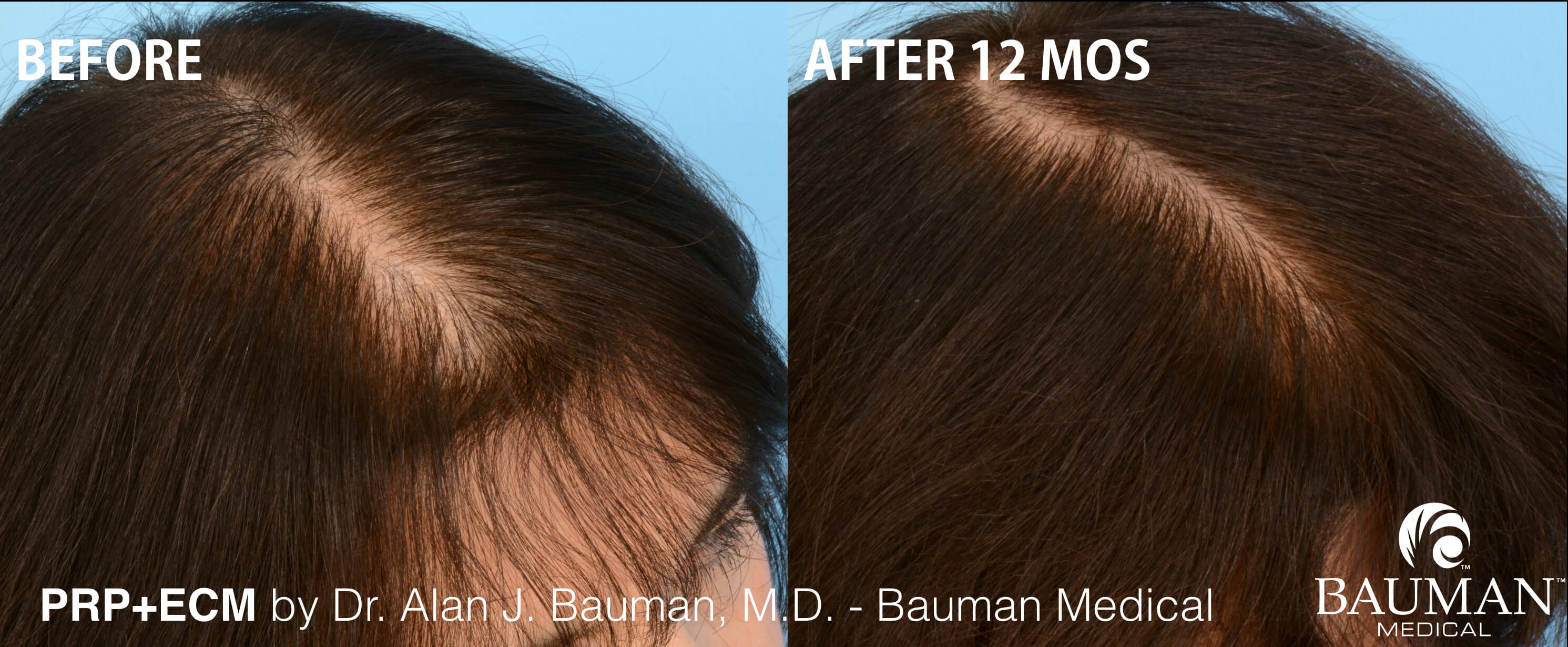 Vampire-Prp Treatment For Hair Loss Prp Female Before-After_002_Dralanbauman