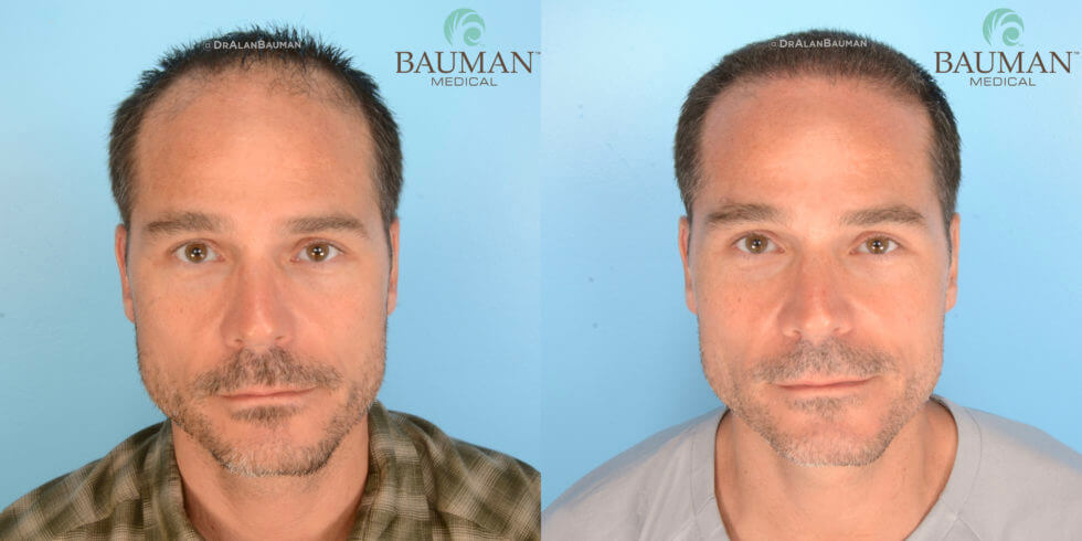 Article: Smartgraft Is Not Your Father'S Hair Transplant Dr. Alan Bauman Smartgraft Fue Patient Brian Hair Transplant Results After 12 Months. Front Photo.