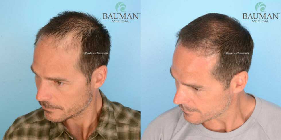Article: Smartgraft Is Not Your Father'S Hair Transplant Dr. Alan Bauman Smartgraft Fue Patient Brian Hair Transplant Results After 12 Months. Side Photo.