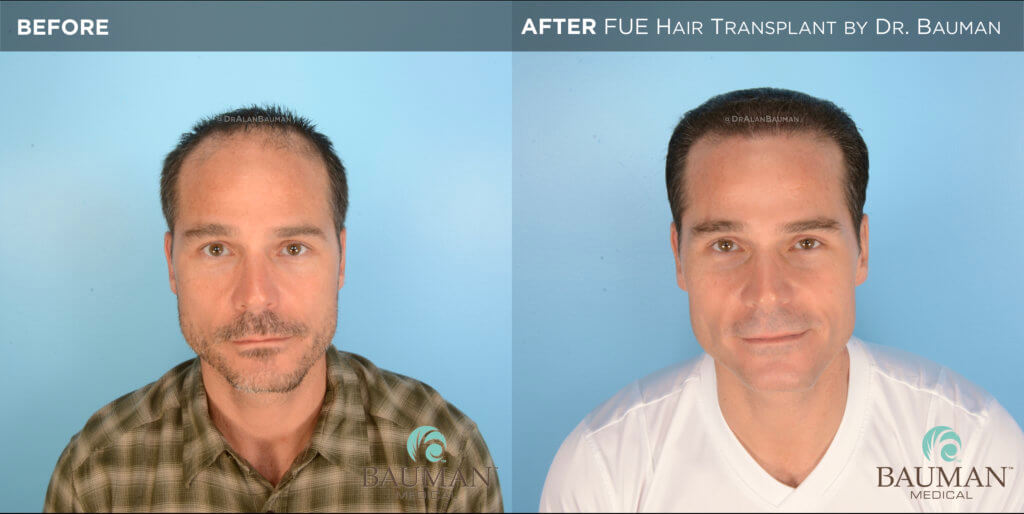 Smartgraft Fue Hair Transplant Results From Dr. Alan Bauman Fue Before After 12Mos - Brian - Dr Alan Bauman.001