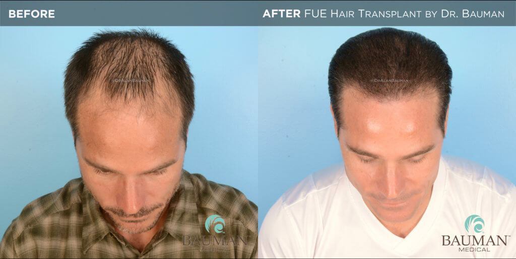 Smartgraft Fue Hair Transplant Results From Dr. Alan Bauman Fue Before After 12Mos - Brian - Dr Alan Bauman.003