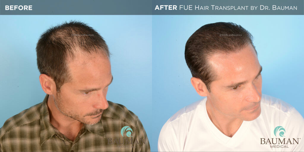 Smartgraft Fue Hair Transplant Results From Dr. Alan Bauman Fue Before After 12Mos - Brian - Dr Alan Bauman.004