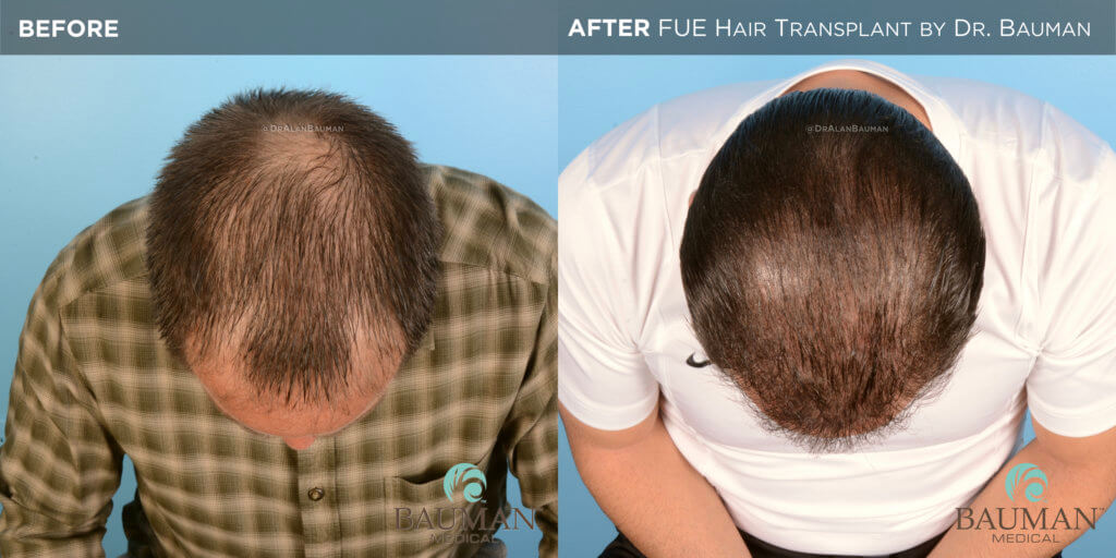 Smartgraft Fue Hair Transplant Results From Dr. Alan Bauman Fue Before After 12Mos - Brian - Dr Alan Bauman.005