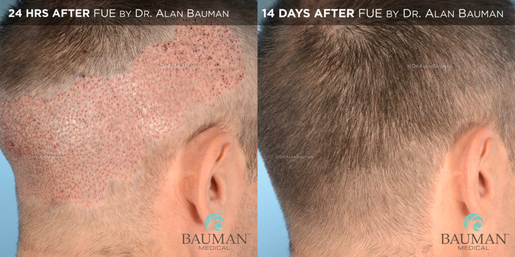 Smartgraft Fue Hair Transplant Results From Dr. Alan Bauman Fue Donor Area 24Hrs + 14Days - Brian - Dr Alan Bauman.006