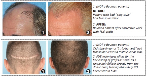Article: Hair Transplant Dos And Donts Dont: Bad Hair Plugs And Linear Scars