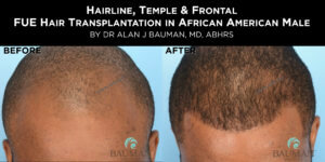 Before-After: African Afro Caribbean Ethnic Fue Hair Transplant Using Smartgraft Before-After: African Afro Caribbean Ethnic Fue Hair Transplant Using Smartgraft - -