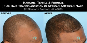 Before-After: African Afro Caribbean Ethnic Fue Hair Transplant Using Smartgraft Before-After: African Afro Caribbean Ethnic Fue Hair Transplant Using Smartgraft - -