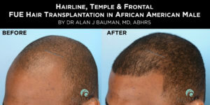 Before-After: African Afro Caribbean Ethnic Fue Hair Transplant Using Smartgraft Before-After: African Afro Caribbean Ethnic Fue Hair Transplant Using Smartgraft - -