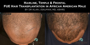 Before-After: African Afro Caribbean Ethnic Fue Hair Transplant Using Smartgraft Before-After: African Afro Caribbean Ethnic Fue Hair Transplant Using Smartgraft - -