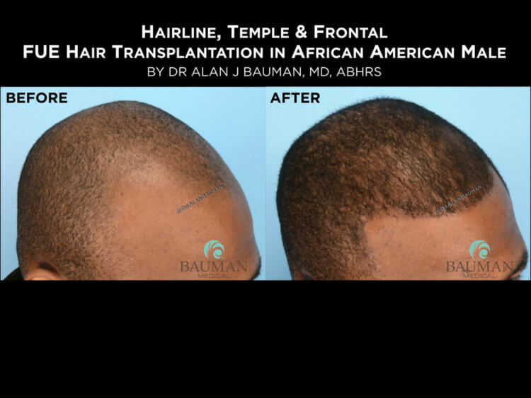Q: Does Hair Transplantation Work for Ethnic or African American Hair?