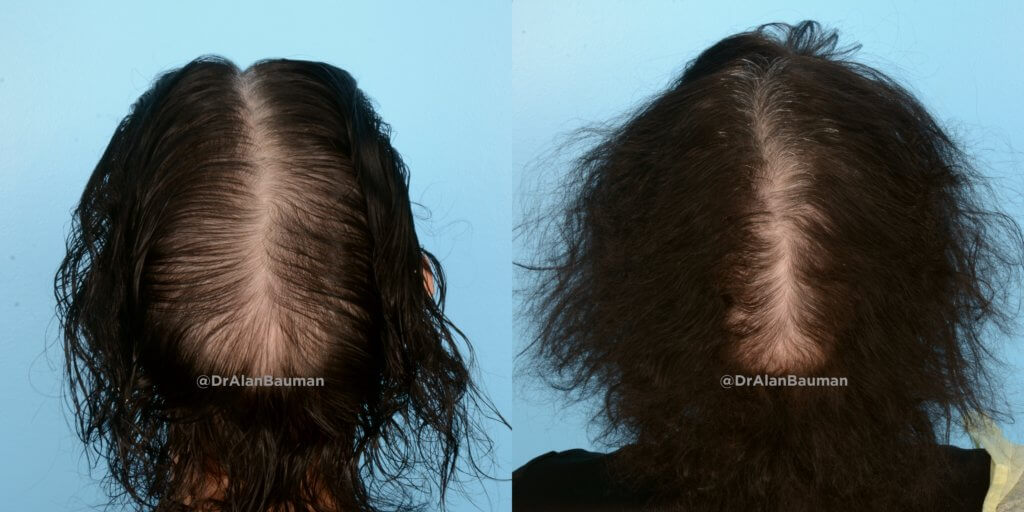 Pdogro: Pdo Polydioxanone Threads For Hair Regrowth Crown__Pdo_Threads_Drbauman
