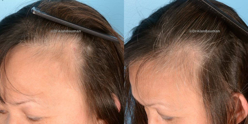 Pdogro: Pdo Polydioxanone Threads For Hair Regrowth L-Temple_Pdo_Threads_Drbauman