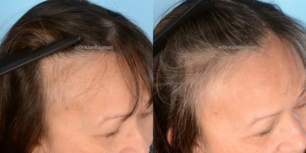 Pdogro: Pdo Polydioxanone Threads For Hair Regrowth R_Temple__Pdo_Threads_Drbauman