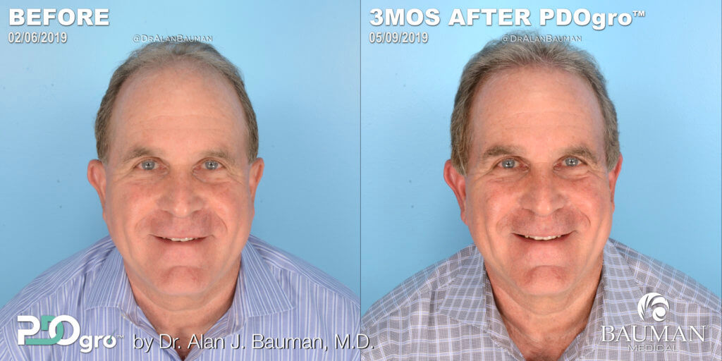 Pdogro: Pdo Polydioxanone Threads For Hair Regrowth Before And 3 Months After Pdogro Procedure By Dr. Alan Bauman For Male Pattern Hair Loss.