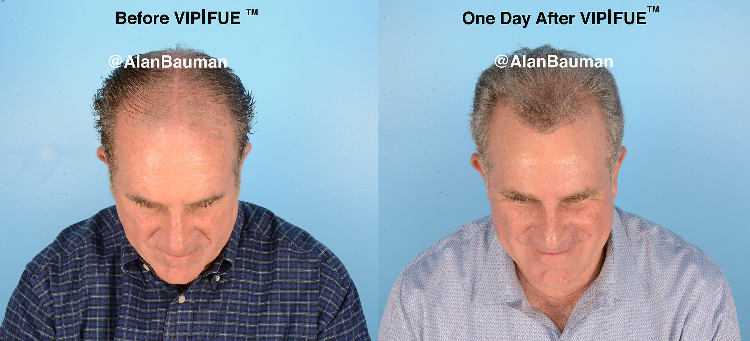 Vip|Fue&Trade; No Shave Long Hair Preview Hair Transplant Before After No Shave Vip Fue Hair Transplant