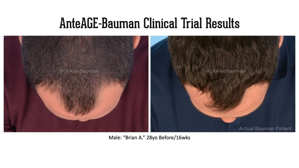 Virtualprp Anteage-Md Clinical Trial Before+After Results Bauman-Anteage Clinical Trial Results_28M-Top