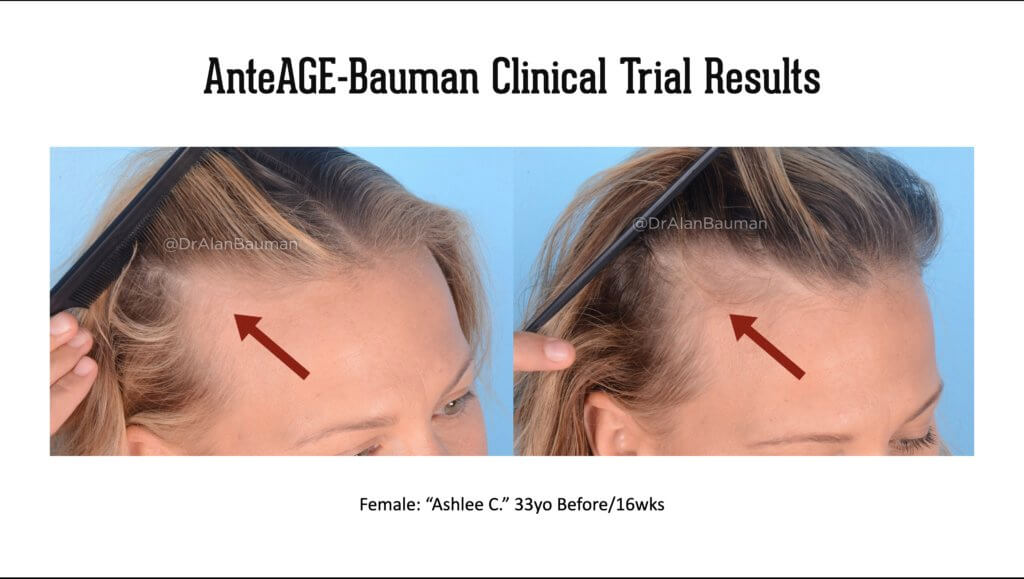 Virtualprp Anteage-Md Clinical Trial Before+After Results Bauman-Anteage Virtualprp Clinical Trial Results 33Female-Temples