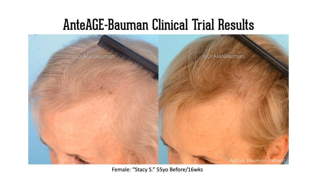 Virtualprp Anteage-Md Clinical Trial Before+After Results Virtualprp Anteage-Md Clinical Trial Before+After Results - -