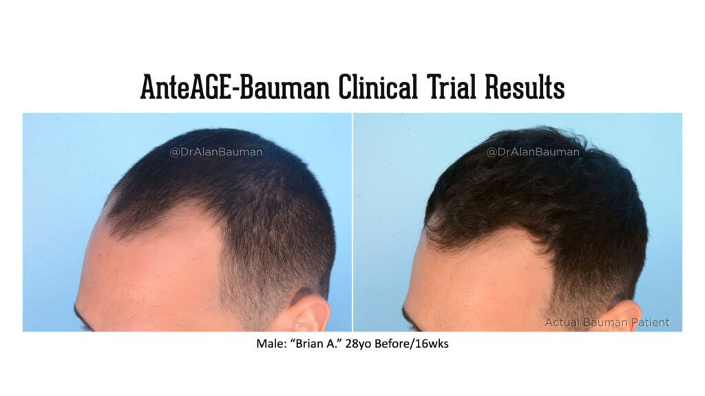 Virtualprp Anteage-Md Clinical Trial Before+After Results Bauman-Anteage Clinical Trial Virtualprp Results_28M-Temples