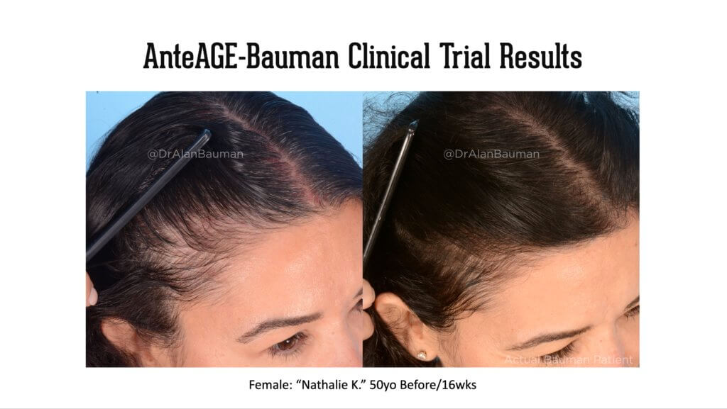 Virtualprp Anteage-Md Clinical Trial Before+After Results Bauman-Anteage Clinical Trial Results Virtualprp 50F-Temples