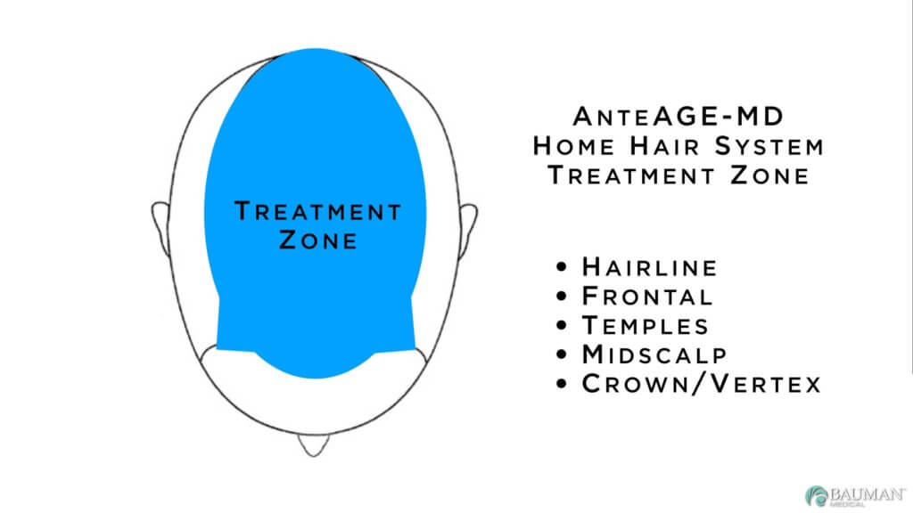 What Is Virtualprp And Anteage-Md Home Hair System? Anteage-Md-Home-Hair-System-Treatment