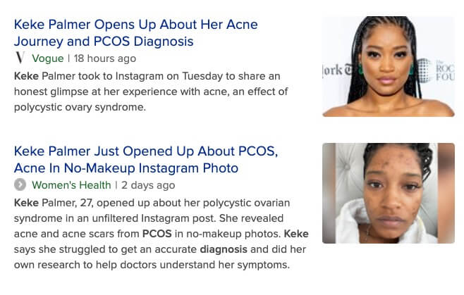 How To Avoid And Treat Pcos Hair Loss Keke Pcos Acne Hair Loss Dralanbauman