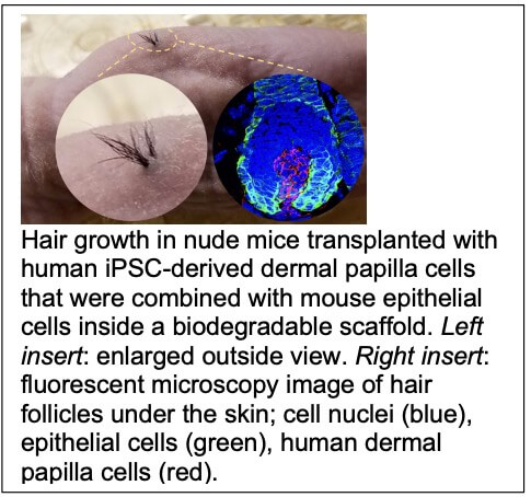 Regenerative Medicine In Hair Restoration Ipscs Were Used To Create Dermal Papilla Cells And New Hair Follicles In The Nude Mouse A Terkskikh