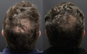 Introducing Alma Ted Transepidermal Delivery For Hair Shedding And Hair Loss Introducing Alma Ted Transepidermal Delivery For Hair Shedding And Hair Loss - -