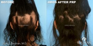 Article: New Drug Just Approved For Hair Growth. Should You Try It? Before And 4 Months After Prp For Alopecia Areata By Dr. Alan Bauman
