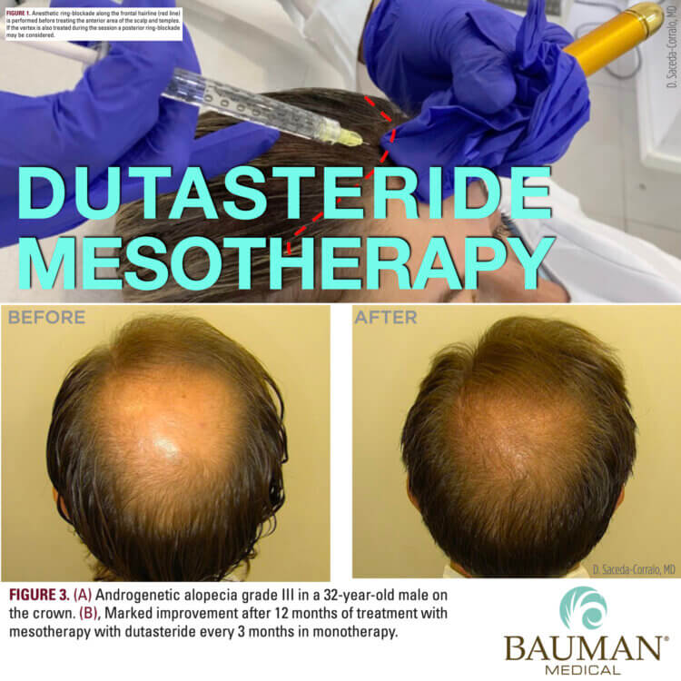 What is Dutasteride Mesotherapy?