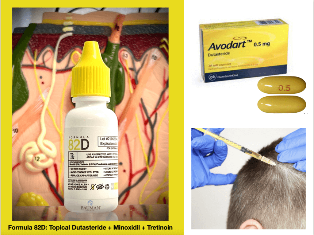 Is Dutasteride The Strongest Hair Loss Drug? Avodart Dutasteride Pills Mesotherapy 82D Topical