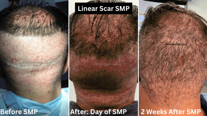 Smp Scalp Micropigmentation Smp Scalp Micropigmentation - -
