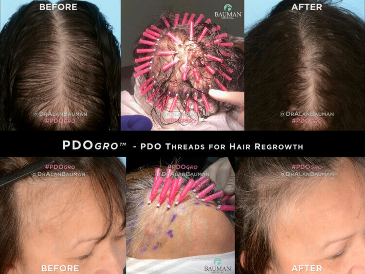 Does PRP work for hair regrowth? (Yes, but…)